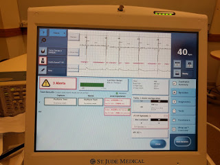 Correlation is Not Causation: Electrical Analysis of St. Jude Implant Shows Normal Pacing