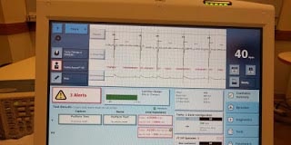 Correlation is Not Causation: Electrical Analysis of St. Jude Implant Shows Normal Pacing